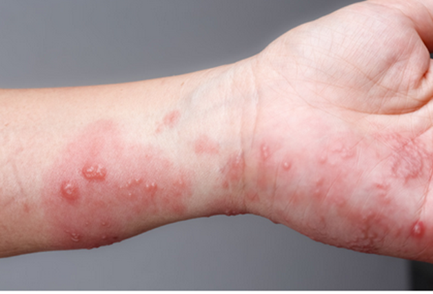 Acute inflammation can cause redness and swelling of the tissues